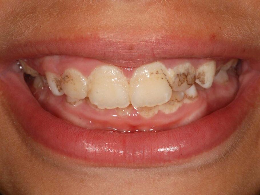 Nhiễm Sắc Ngoại Sinh Trên Răng (Chromogenic Stains)