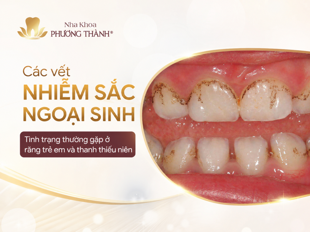Các vết nhiễm sắc ngoại sinh – tình trạng thường gặp ở răng trẻ em và thanh thiếu niên