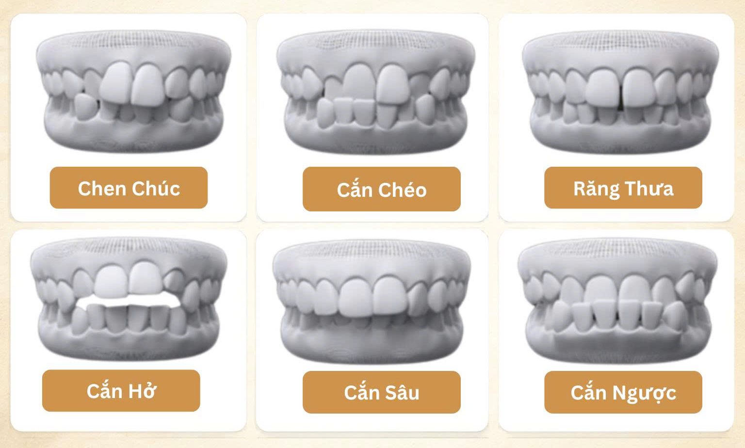 Hình ảnh ca điều trị niềng răng tại Nha khoa Phương Thành