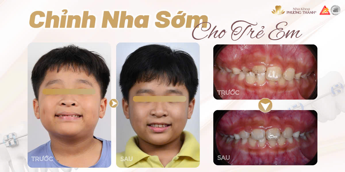 Con còn nhỏ, có cần niềng răng sớm không?