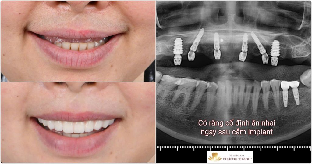 Cấy Implant – Có răng tức thì, không gián đoạn cuộc sống