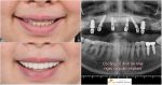 Cấy Implant – Có răng tức thì, không gián đoạn cuộc sống